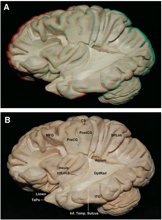 optRad Limon repo Inf. Temp. Sulcus FIGURE 6. Images in 3 (A) and 2 (B) dimensions. Lateral' view. The superior, middle temporal, angular, and occipital gyri were removed. Observe rhe optic radiation located deep to the superior and middle temporal gyri, above the inferior temporal sulcus. CS, central sulcus; Inf Temp. Sulcus, Inferior temporal sulcus; inferior limiting sulcus; IT G, inferior temporal gyrus; MFG, middle frontal gyms; optic radiation; PostCG, Postcentral gyms; PreCG, precentral gyms; SPLob, superior parietal lobe; TePo, temporal pole. FIGURE 7. Images in 3 (A) and 2 (B) dimensions. Lateral view of left hemisphere. Parts of the superior longitudinal fasciculus (Sup LongFasc) were removed to expose the corona radiata and the sagittal stratum (SagStr). Occi- pitofrontal (OcFrFasc) and uncinate fasciculus (UncFasc) can be identified Passing along the basal portion Of the insular cortex. AntCom, anterior com- missure; CORa, corona radia'e; Glopa, globus pallidus. 