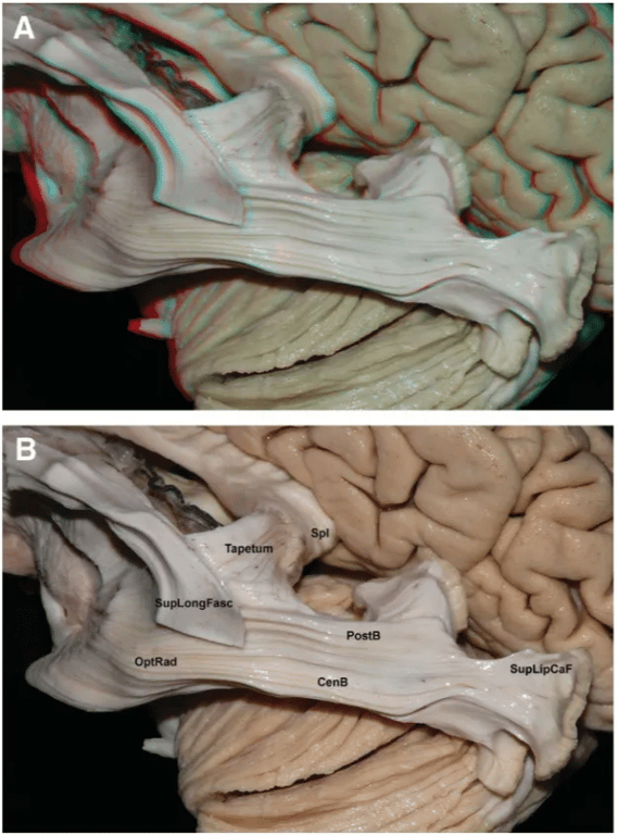 Spl Glopa Meyer-s loop CenB TapetumCS OptRad supLiöCaF DiBandBr AntCom FIGURE 4. Images in 3 (A) and 2 (B) dimensions. Lateral view. Optic radiation (OptRad) of the left hemisphere; the section of the superior longitudinal lus (SupLongFasc) allows exposure Of the central (CenB) and posterior bundles (PostB), which end at the lateral aspect of occipital pole and superior lip of the calcarinefissure, respectively. AntCom, anterior commissure; CalV, caudate nucleus; CORa, corona radiata; DiBandBr, diagonal band of Broca; GloPa, globus pallidus; IntCap, internal capsule. FIGURE 5. Images in 3 (A) and 2 (B) dimensions. Magnified view of the trajectory of 'be central and posterior bundles. The taperum constitutes the medial roof of the ventricular atrium. CenB, central bundle; OptRad, optic radiation; PostB, posterior bundle; SupLipCaF, superior lip of the calcarine fissure; SupLongFasc, superior longitudinal fasciculus; Spl, splenium Of the corpus callosum. 