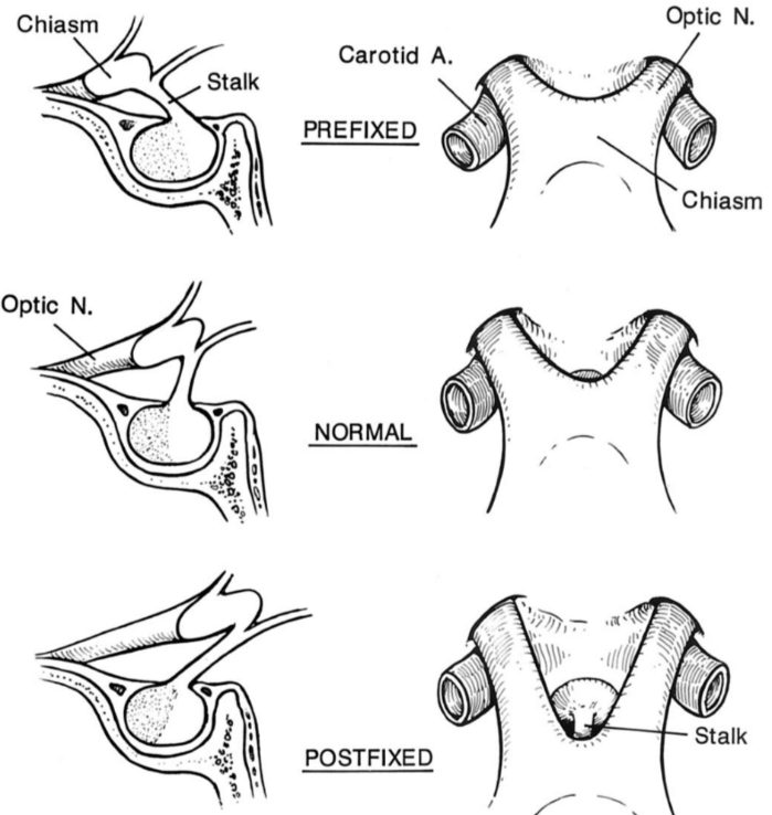 Chiasm Stalk Optic N. Carotid A. PREFIXED NORMAL POSTFIXED Optic N. Chiasm stalk 