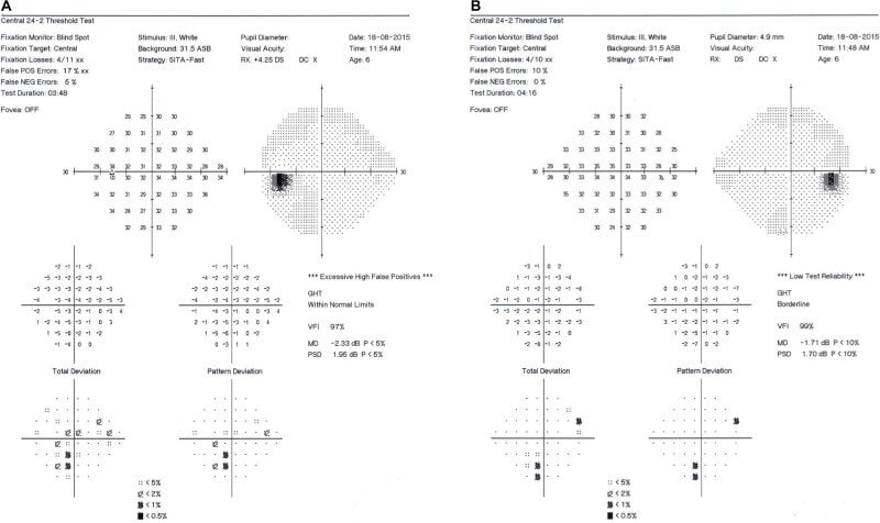Humphrey visual field of patient’s left (A) and right (B) eyes.