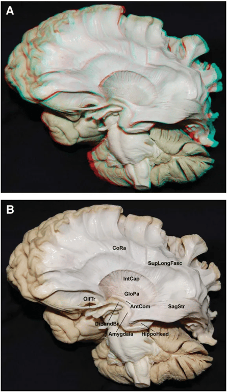 Fasc XAntCom— FIGURE I O. Images in 3 (A) and 2 (B) dimensions. Anterolateral view of the left hemisphere. The occipitøfrontal and the uncinate and the putamen were removed m expose the anterior commissure. The diagonal band of Broca (DiBandBr) and its junction with rhe amygdala are inferior to the lateral aspect Of the anterior commissure (AntCom). CORI, corona radiata,• Glopa, globus pallidus; HippoHead, head Of the hippocampus; IntCap, internal capsule; SagStr, saginal stratum; SupLongFasc, superior longitudinal fasciculus. 