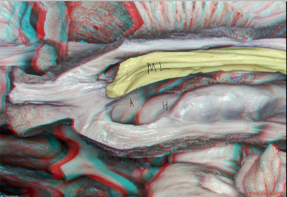 Lateral view: Meyer's loop (ML), Amygdala (A), Hippocampus located in the floor of temporal horn