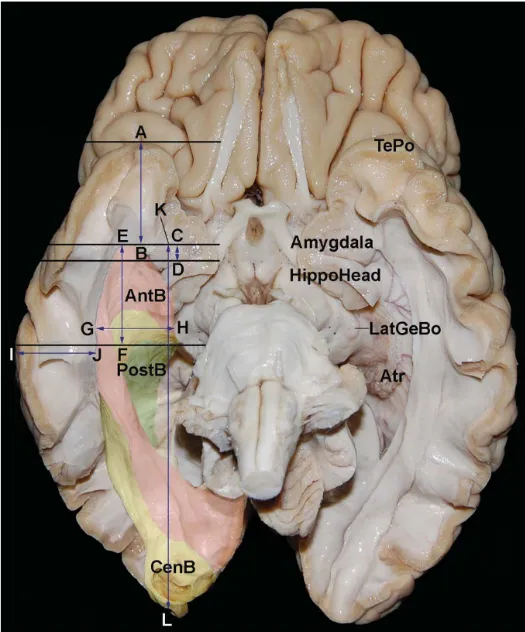 Tep Amygdala ead Anta • —L,atGeBo post FIGURE I. Inferior Of the optic radiation with the measurements that were done. A-B, the distance between temporalpole (TePo) and the anterior edge of the Meyer loop. C-D, distance between the anterior wall of temporal horn and the anterior edge Of the Meyer loop. E-F, distance between the anterior edge Of the Meyer loop and the lateral geniculate body (LatGeBo). G-H, distance between the lateral geniculate body and the lateral edge of the optic radiation. I-J, distance between the cortical surface ofthe middle temporalgyrus and lateral edge Of the optic radiation. K-L length Of the optic radiation. AntB, anterior bundle; Atr, atrium of lateral ventricle; CenB, central bundle; HippoHead, head of the hippocampus; PostB, posterior bundle. 