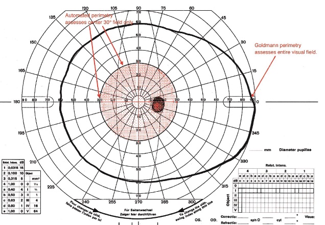 Goldman Perimetry - American Academy of Ophthalmology