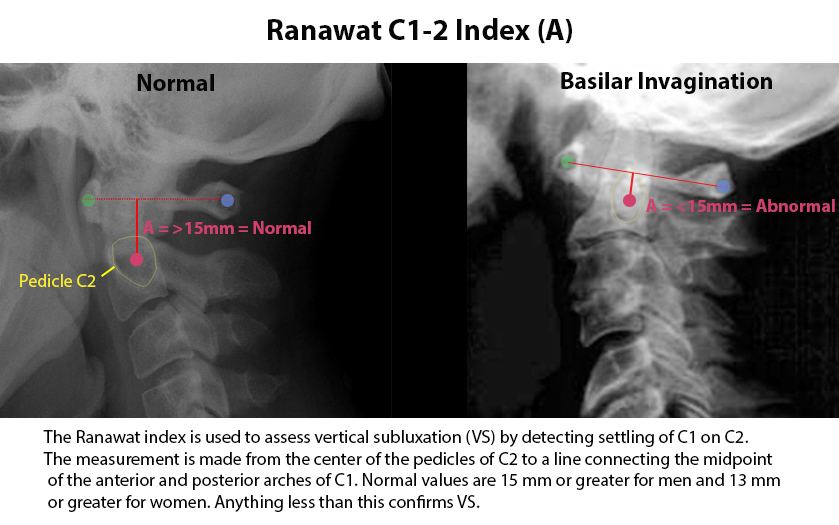 Rheumatoid Cervical Spondylitis - Spine - Orthobullets