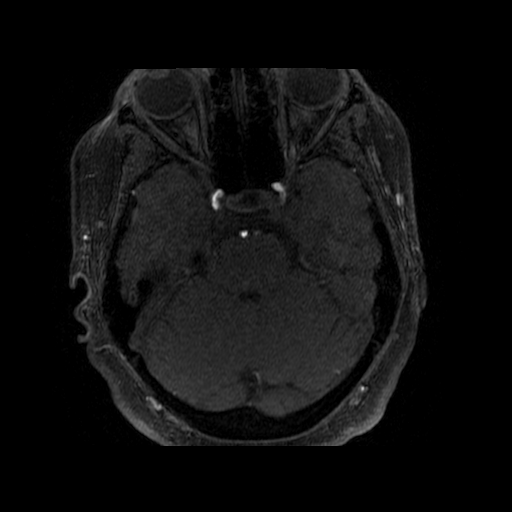 MRA demonstrating dissection flap in R cavernous ICA