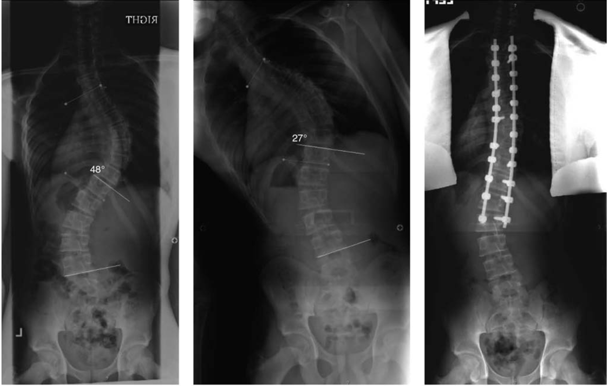 Preoperative (A and B) and 1-year postoperative (C) PA radiographs of a 15-year-old girl with a 63° thoracic curve and a 48° lumbar curve. This is a double major curve (ie, Lenke type 3B). The thoracic curve bends to 52° on the right- bending radiograph (A), and the lumbar curve bends to 27° on the left-bending radiograph (B). L1 is the stable vertebra of the thoracic curve, and T12 is the lowest vertebra touching the central sacral vertical line (CSVL). L5 is the stable vertebra of the lumbar curve, and L4 is the lowest one touching the CSVL. L1 and L5 are neutral vertebrae. The horizontal disk on the left-bending radiograph is L3/4 (panel B). Clavicular height was−1.5 cm. There was no segmental kyphosis of >20°. Fusion to L3 (ie, vertebra just proximal to the horizontal disk on left-bending radiograph) likely would have prevented postoperative disk wedging.