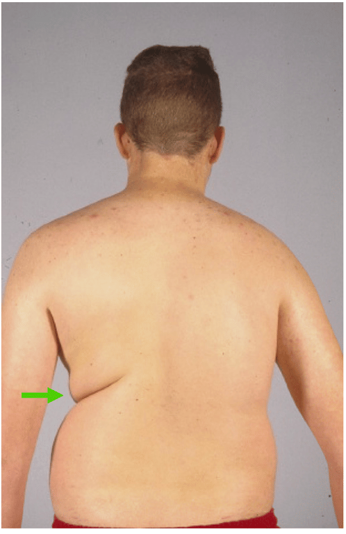 Flank asymmetry. Cleft on side of curve concavity (arrow).