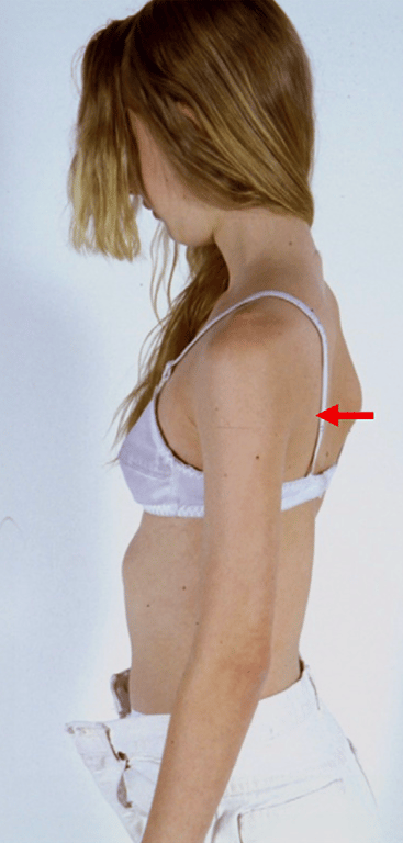 Thoracic hypokyphosis (arrow).