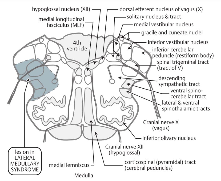 hypoglossal nucleus (Xll) medial longitudinal lesion in LATERAL MEDULLARY SYNDROME fasciculus (MLF) 4th ventricle medial lemniscus Medulla dorsal efferent nucleus of vagus (X) solitary nucleus & tract medial vestibular nucleus gracile and cuneate nuclei inferior vestibular nucleus inferior cerebellar peduncle (restiform body) spinal trigeminal tract (tract of V) descending sympathetic tract ventral spino- cerebellar tract lateral & ventral spinothalamic tracts Cranial nerve X (vagus) inferior Olivary nucleus Cranial nerve Xll (hypoglossal) corticospinal (pyramidal) tract (cerebral peduncles) 