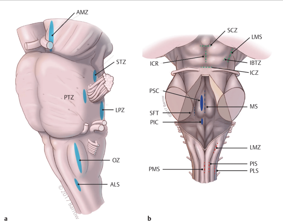 Main safe entry zones to the brainstem. The colored ovals and dashed lines represent points where small neurotomies are possible to avoid small perforators, main nerve tracts, and nuclei. 
(a) Anterolateral view of brainstem illustrating some anterior and anterolateral safe zones. 
(b) Posterior view of brainstem demonstrating the safe entry zones on the surface of the quadrigeminal plate (green dashed lines), floor of the fourth ventricle (blue dashed lines and colored ovals), and lower medulla (red dashed lines). 