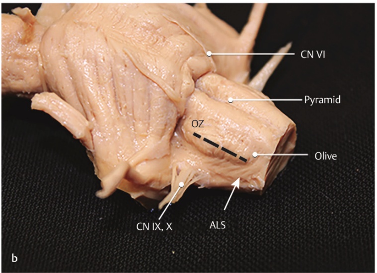 Close-up of a human heart AI-generated content may be incorrect.