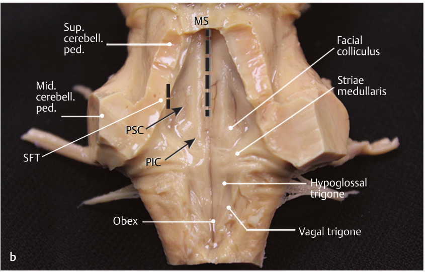 A close-up of a bone AI-generated content may be incorrect.