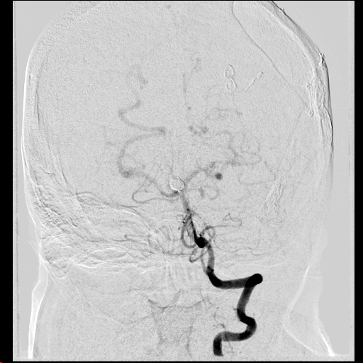 L ICA occlusion on same patient