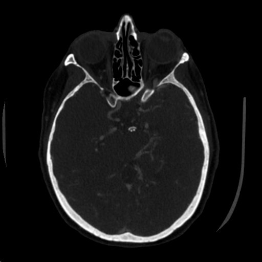 abrupt cutoff of L ICA around paraclinoid segment is demonstrated

DSA: 