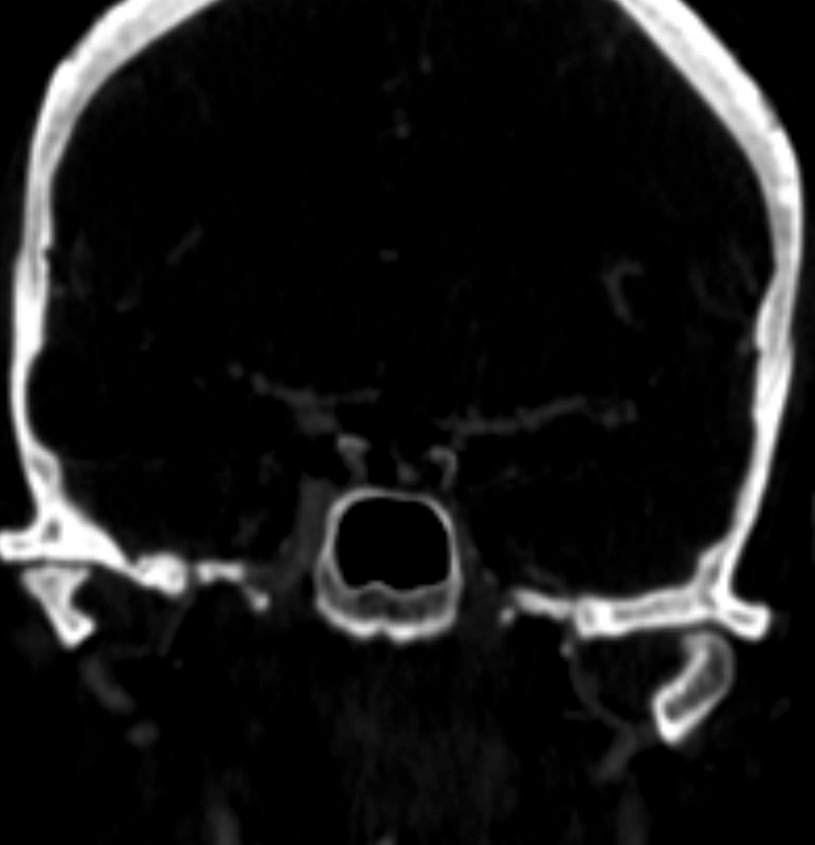 general diminutive caliber of L ICA intracranially is demonstrated