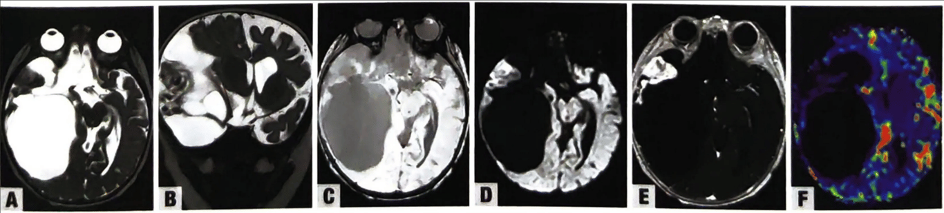 Desmoplastic infantile ganglioglioma in the right hemisphere of an 18-month-old girl. Axial (A) and coronal (B) T2-weighted MRI shows multiple cystic components with cerebrospinal fluid–like signal, and a peripheral solid component that is isointense to grey matter. C, Susceptibility-weighted MRI shows no blooming effect (pseudoenlargement of the lesion). D, Diffusion-weighted MRI demonstrates a solid hyperintense portion, possibly due to desmoplastic reaction. E, Contrast-enhanced T1-weighted MRI shows intense homogeneous enhancement of the solid component and no enhancement of the cyst walls. F, Colour cerebral blood volume map (dynamic susceptibility contrast perfusion) shows relative hyperperfusion of the solid enhancing component compared with the contralateral white matter.