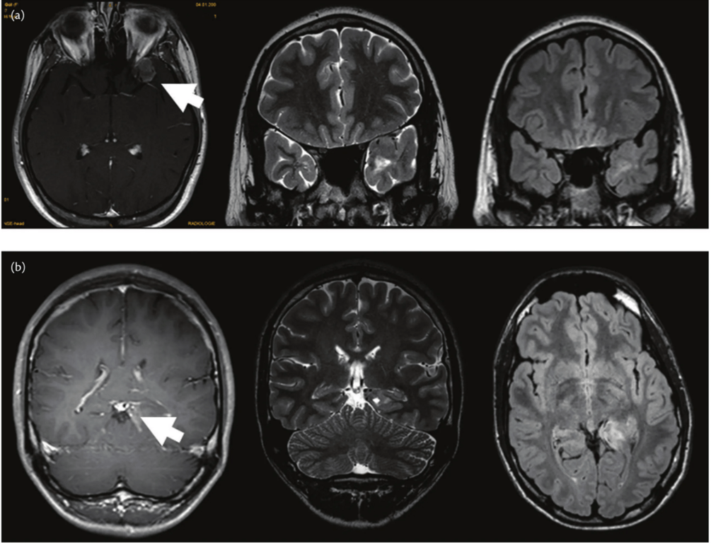(A) Right frontoparietal desmoplastic infantile gangliogliomas (DIG) in an 8 months female infant. (B) Atypical extraventricular neurocytoma WHO grade II growing in the dorsal thalamus and middle temporooccipital gyrus. The tumour occurred in a 25-year-old female with hydrocephalic symptoms.