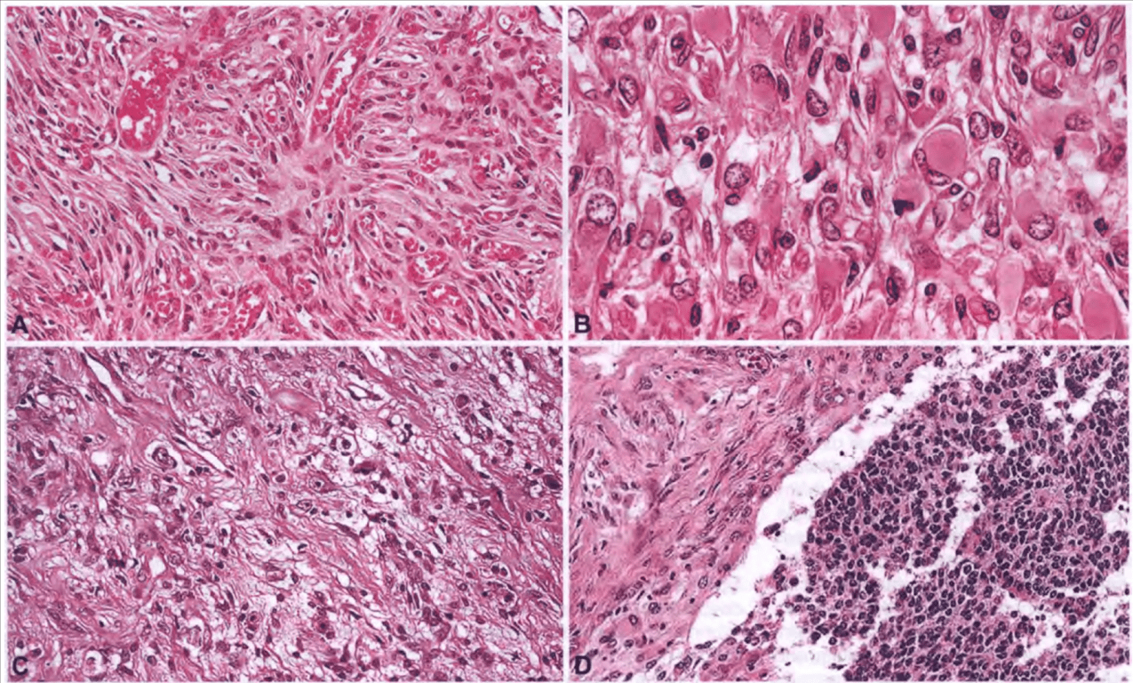 A, Desmoplastic infantile cerebral astrocytoma. Neoplastic astrocytes arranged in streams with (B) a field of gemistocytic neoplastic astrocytes. C, Desmoplastic infantile ganglioglioma with scattered ganglion cells and (D) low-grade spindle cells in a collagen-rich matrix and a component of primitive small blue round cells.