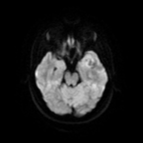 A mri of a brain AI-generated content may be incorrect.