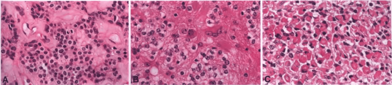 Fig. 6.28 Papillary glioneuronal tumour. A Mitotic figures are rarely seen. B Ganglioid cells and neurocytes with fibrillary neuropil. C Minigemistocytes are occasionally observed In some cases. 