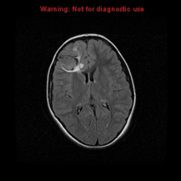 A close-up of a brain scan AI-generated content may be incorrect.