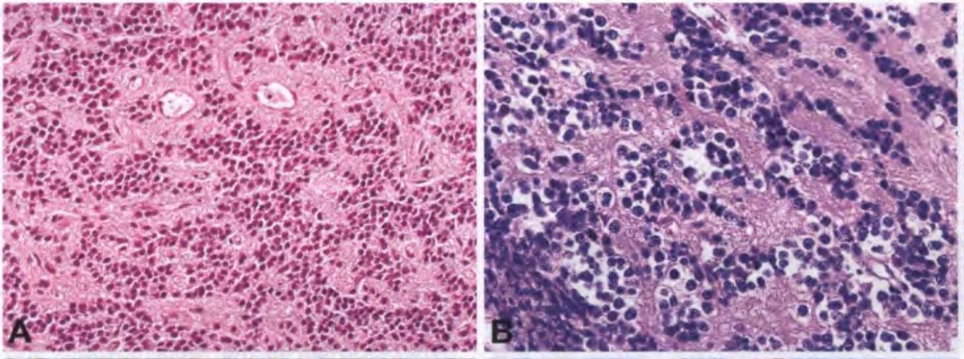 Round cells with nucleus-free areas of neuropil