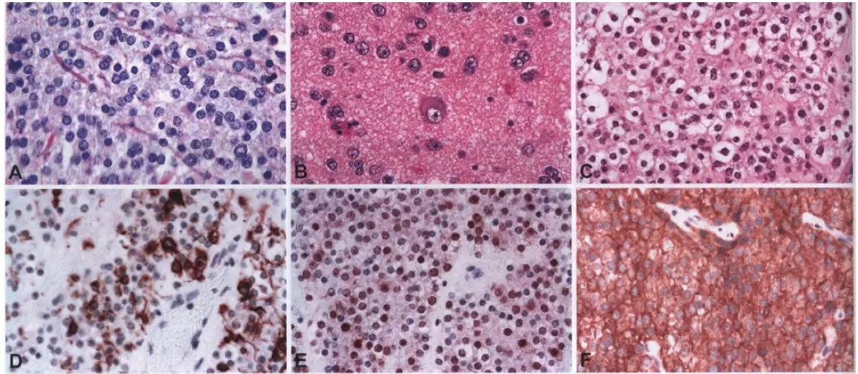 Machine generated alternative text: Fig. 6.45 Extraventricular neurocytoma. A Spinal extraventricular neurocytoma composed of monomorphic cells that have round nuclei with fine nuclear chromatin. B Focal ganglionic differentiation. C The cells, often with perinuclear haloes, have round nuclei with finely stippled chromatin and small nucleoli. D Occasional neoplastic cells express GFAP. E Nuclear expression of NeuN. F Diffuse cytoplasmic Immunoreactivity for synaptophysin is characteristic of extraventricular neurocytoma. The sparse neuropil between tumour cells is also stained. 