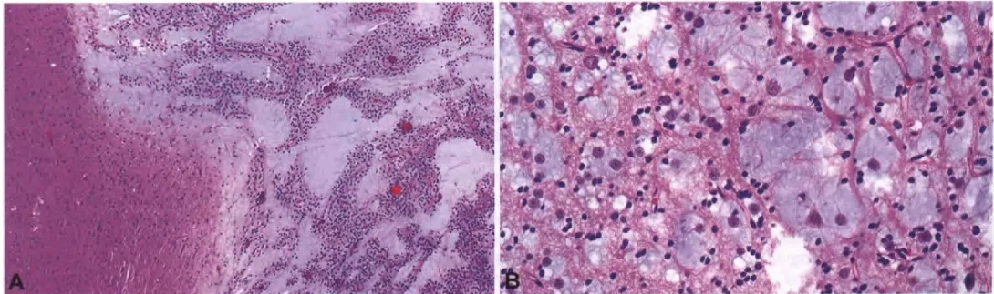 Fig. 6.05 Dysembnjoplastic neuroepithelial tumour. A Mucin-rich cortical nodule with columnar architecture. B The so-called specific glioneuronal element is characterized by oligodendrocyte-like cells embedded in a mucoid matrix with interspersed floating neurons. 