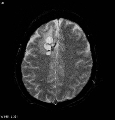 A brain scan of a person AI-generated content may be incorrect.