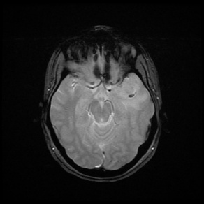 A mri of a brain AI-generated content may be incorrect.