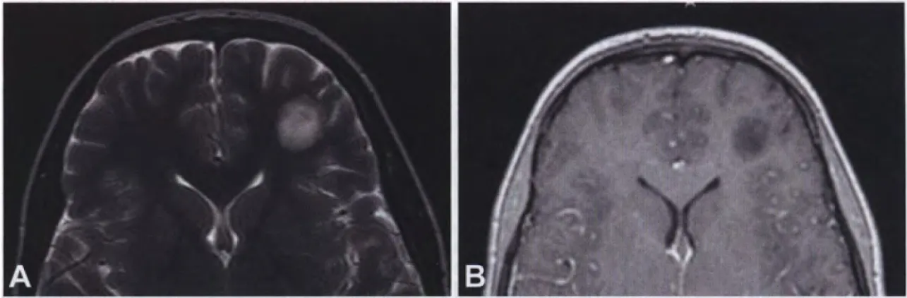 Fig. 6.44 Extraventricular neurocytoma. A Hyperintense frontal mass on T2-weighted MRI. B Hypointense mass with no contrast enhancement is seen on Tl -weighted MRI after gadolinium administration. 