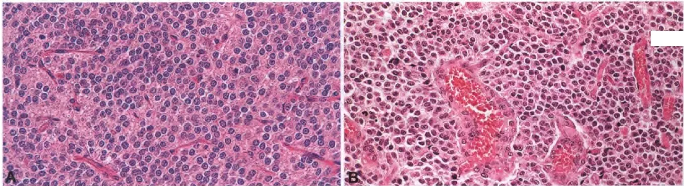 Fig. 6.42 Central neurocytoma. A Round monomorphic cells and vascularized thin-walled capillaries. B Central neurocytoma with anaplastic histological features. Microvascular proliferation associated with mitotic activity. 