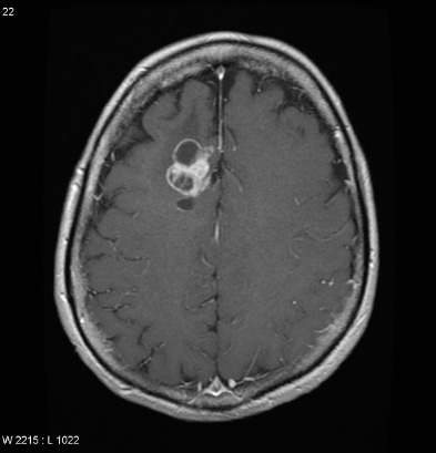 A close-up of a brain scan AI-generated content may be incorrect.