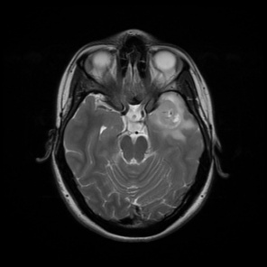 A close-up of a mri scan AI-generated content may be incorrect.
