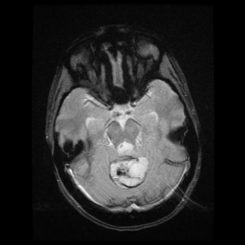 A close-up of a brain scan AI-generated content may be incorrect.