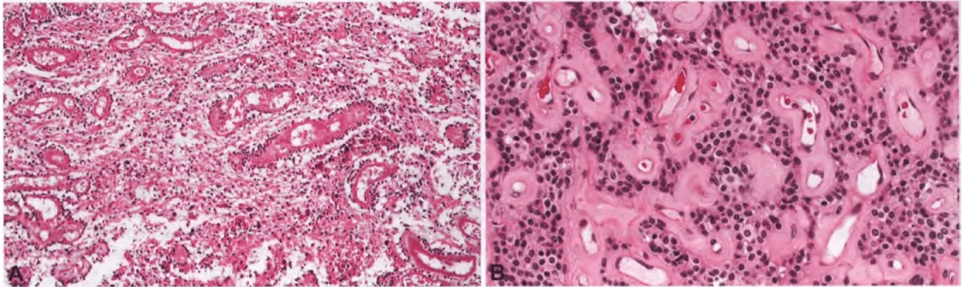 Fig. 6.26 Papillary glioneuronal tumour. A At low magnification, the tumour shows typical papillary structures; vessels are hyalinized and haemosiderin deposits are obvious. B Characteristic pseudopapillary structure with hyalinized blood vessels. 