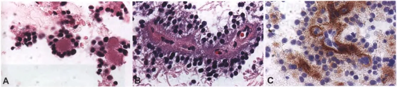 Fig. 6.31 Rosette-forming glioneuronal tumour. A Neurocytic rosette: a ring-like array of neurocytic tumour cell nuclei around an eosinophilic neuropil core. B Perivascular pseudorosette with delicate cell processes radiating towards a capillary. C Synaptophysin immunoreactivity in the pericapillary area of a perivascular pseudorosette. 