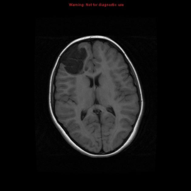 A close-up of a brain scan AI-generated content may be incorrect.