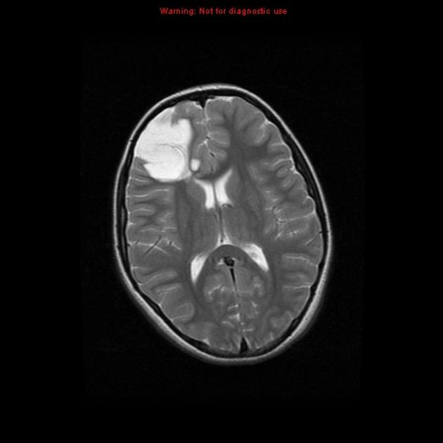 A close-up of a brain scan AI-generated content may be incorrect.