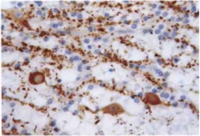 Fig. 6.07 Dysembryoplastic neuroepithelial tumour. Floating neurons show immunoreactivity for synapto- physin, whereas small oligodendrocyte-like cells are immunonegative. 