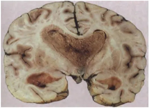 Fig. 6.41 A large central neurocytoma filling both lateral ventricles and extending into the third ventricle and the temporal horn of the left ventricle {1291}. 