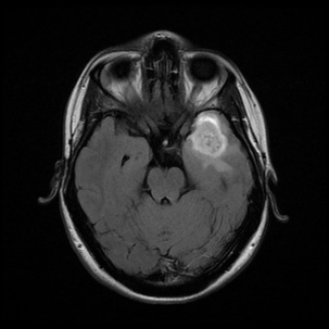 A mri of a brain AI-generated content may be incorrect.