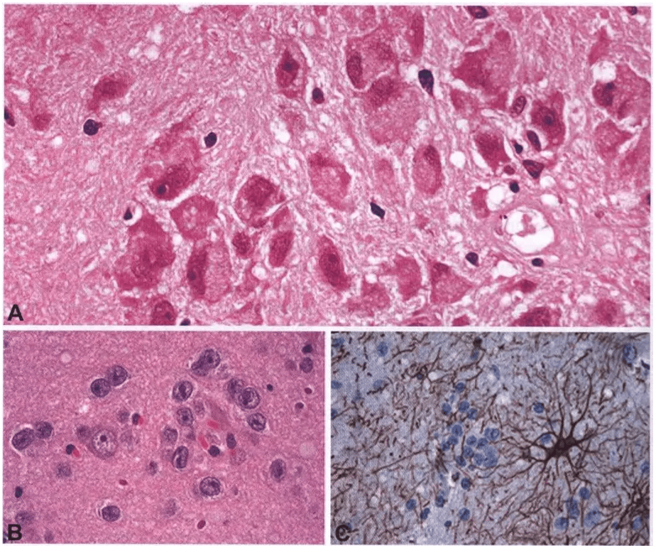 Fig. 6.08 Gangliocytoma. A Focal accumulation of multipolar, dysplastic neurons. B Clusters of mature neurons are embedded in an otherwise normal krain matrix. C Stellate ramification of GFAP-positive astrocytes is compatible voth non-neoplastic nature in a gangliocytoma. 