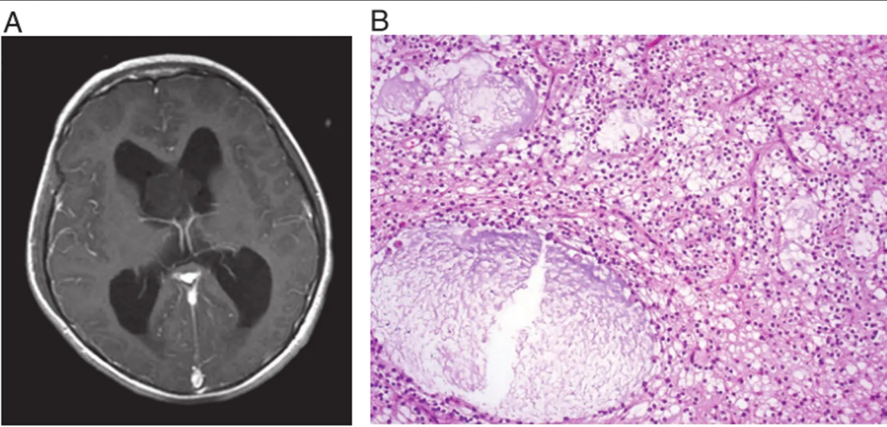 Myxoid glioneuronal tumor is a tumor typically arising in the septal region and involving the lateral ventricle. It is characterized by a proliferation of oligodendrocyte-like tumor cells embedded in a prominent myxoid stroma, often including admixed floating neurons, neurocytic rosettes, and/or perivascular neuropil, and by a dinucleotide mutation in the PDGFRA gene. (A) Common septal location (magnetic resonance imaging, T1 with contrast) and (B) characteristic histological features with small round cells and myxoid stroma (H&E, ×200).