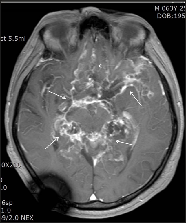 M 063Y 2 DOB:19 st 5.5ml 6sp 9/2.0 NEX 