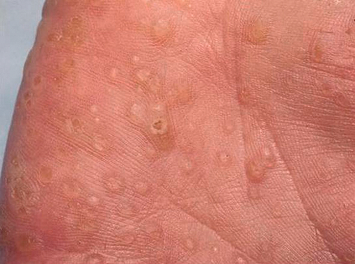 Close-up of a person's skin AI-generated content may be incorrect.