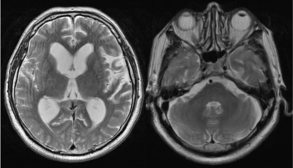 (a) A T2-weighted axial MRI image showing marked dilation of lateral and third ventricles indicating nonobstructive hydrocephalus 