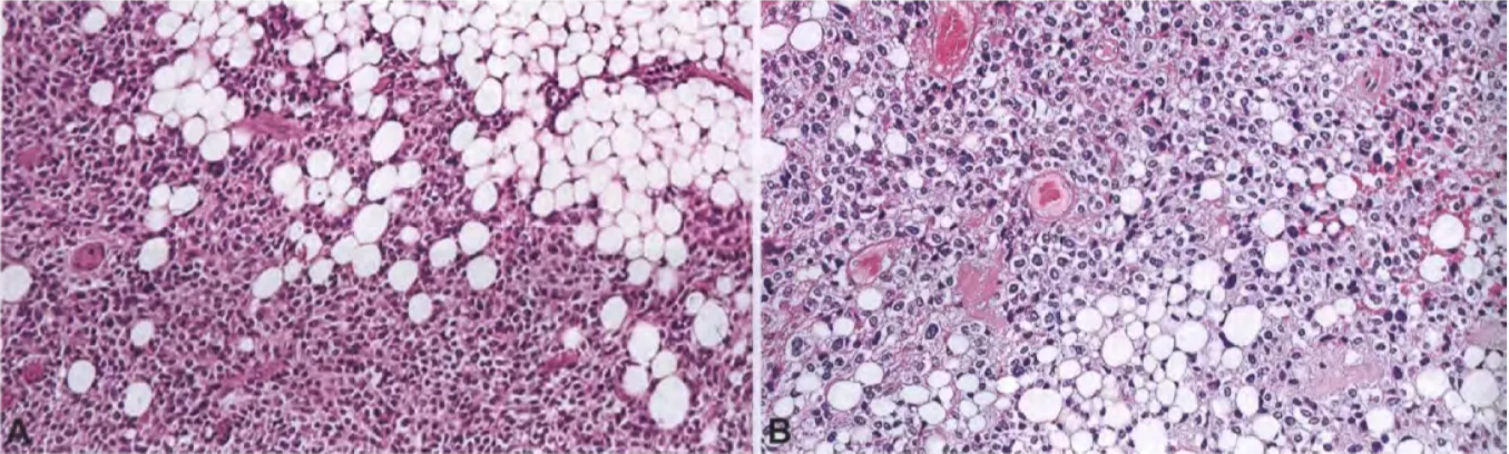 Fig. 6.48 Cerebellar liponeurocytoma. A Typical histology of cerebellar liponeurocytoma with focal accumulation of adipocytic tumour cells on a background of densely packed small round neoplastic cells, which often show a perinuclear halo. B Note the typical focal lipomatous differentiation of tumour cells, with displacementof nuclei to the cell periphery. 
