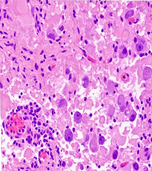 large cells: Ganglion